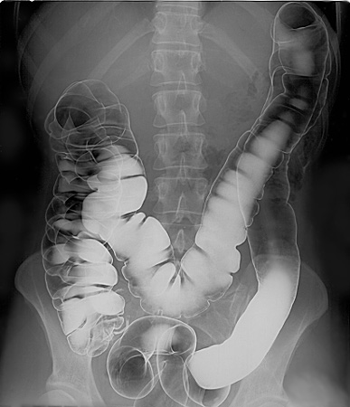 A human intestinal tract vividly illuminated by a barium contrast enema. If not rapidly flushed from the system with oral fluids, the heavy barium can harden and cause mechanical bowel obstructions.