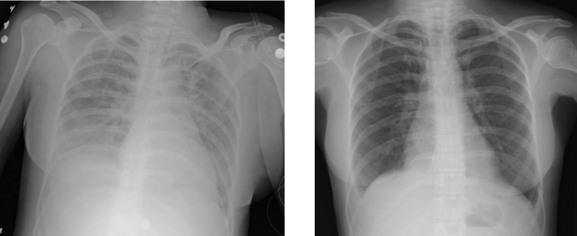 Chest radiograph exhibiting bilateral diffuse pulmonary infiltrates ("white-out" lungs) characteristic of Acute Respiratory Distress Syndrome (ARDS), followed by clearance after clinical intervention.