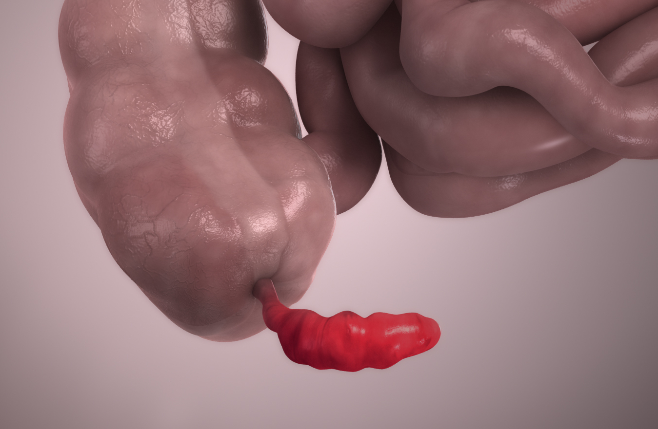The suffix "-itis" indicates inflammation, as illustrated by this 3D model demonstrating acute appendicitis.