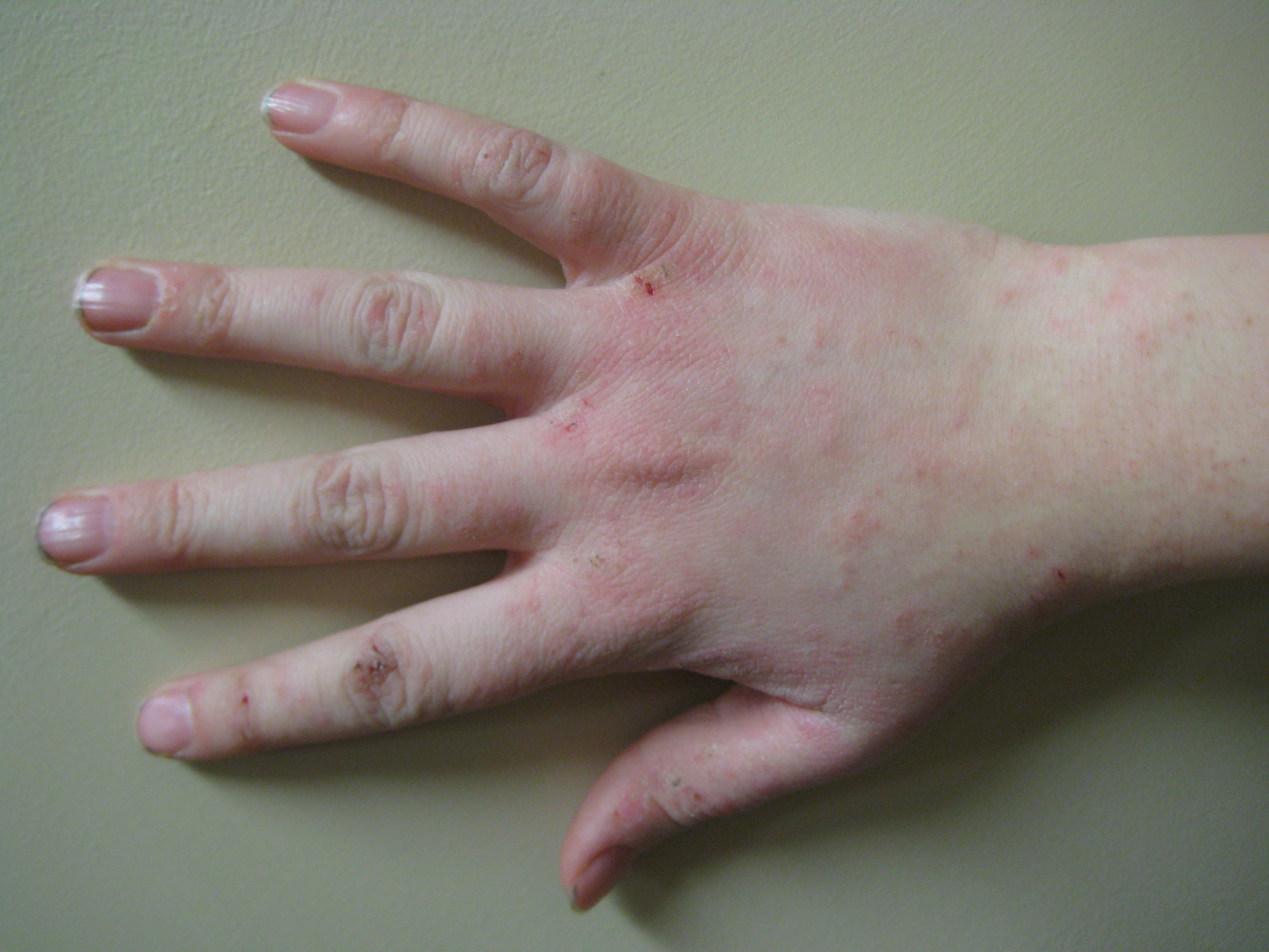 Dermatitis of the hand — the type of injury the claimant suffered in Grant v Australian Knitting Mills after chemical residue was left in woollen underwear during manufacture.