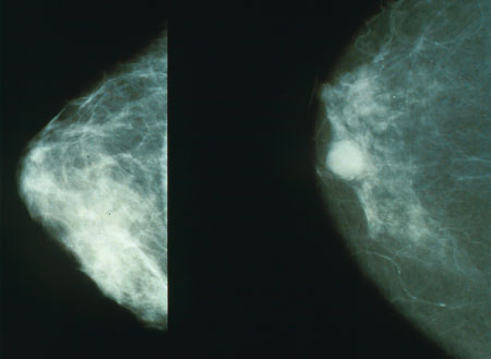 Comparison of a normal mammogram (left) and one displaying a cancerous mass (right), highlighting the clinical importance of regular screening.