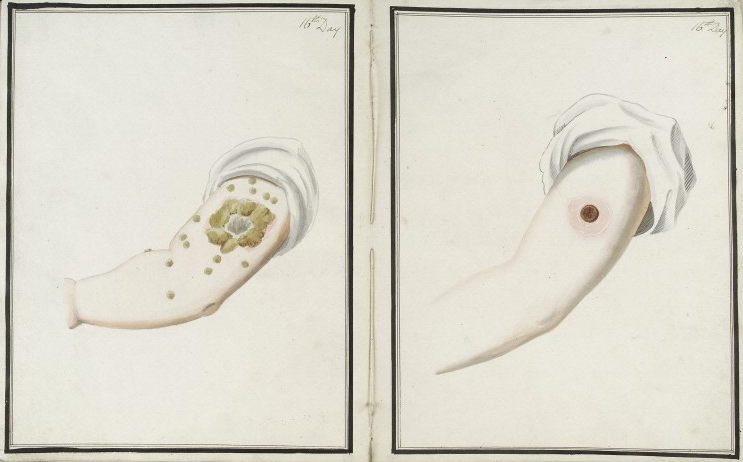 A comparative visual from 1802 highlighting the physiological differences between smallpox and cowpox inoculations, demonstrating how compare-and-contrast structures help evaluate distinct medical options.
