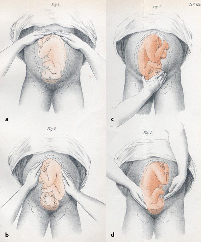 The four systematic steps of Leopold maneuvers, used to manually palpate the maternal abdomen and determine fetal presentation, lie, and position.