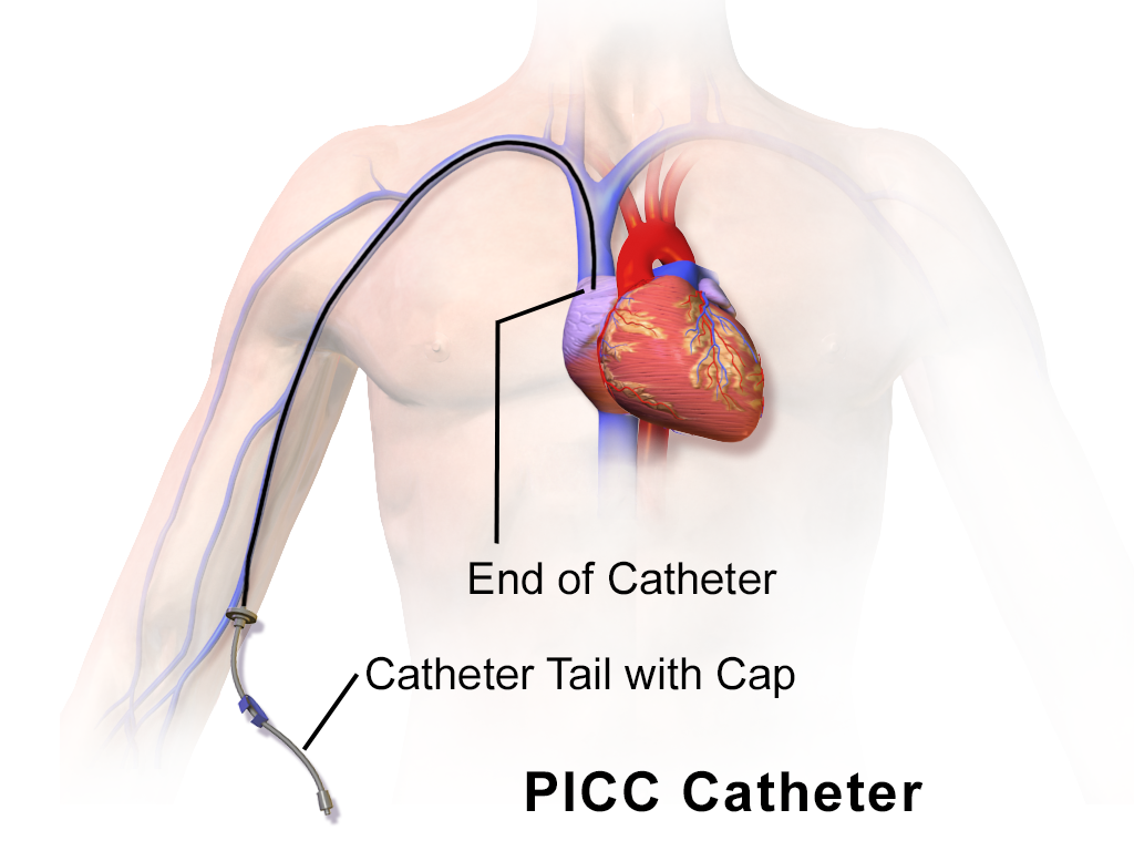 A peripherally inserted central catheter (PICC). When delegating complex and invasive tasks like central line maintenance to a primary caregiver, the nurse must verify their competence through a return-demonstration.