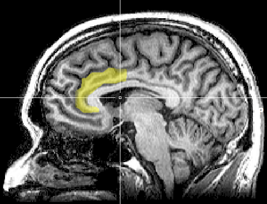 Neuroimaging studies indicate that cognitive dissonance—such as the intense psychological friction experienced during moral distress—creates measurable conflict within the brain's anterior cingulate cortex.