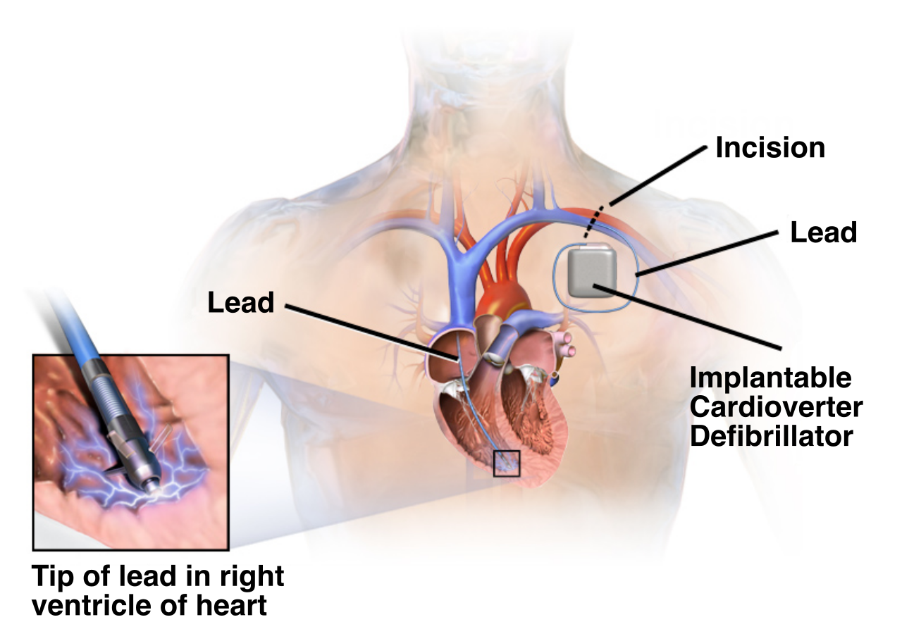 Illustration of an implantable cardioverter-defibrillator (ICD) with its lead placed in the right ventricle to detect and shock life-threatening arrhythmias.