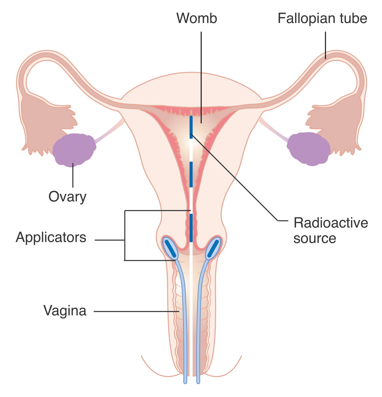 In cervical brachytherapy, applicators are inserted to deliver internal radiation directly to the tumor. The patient themselves becomes a temporary source of ionizing radiation during this treatment.