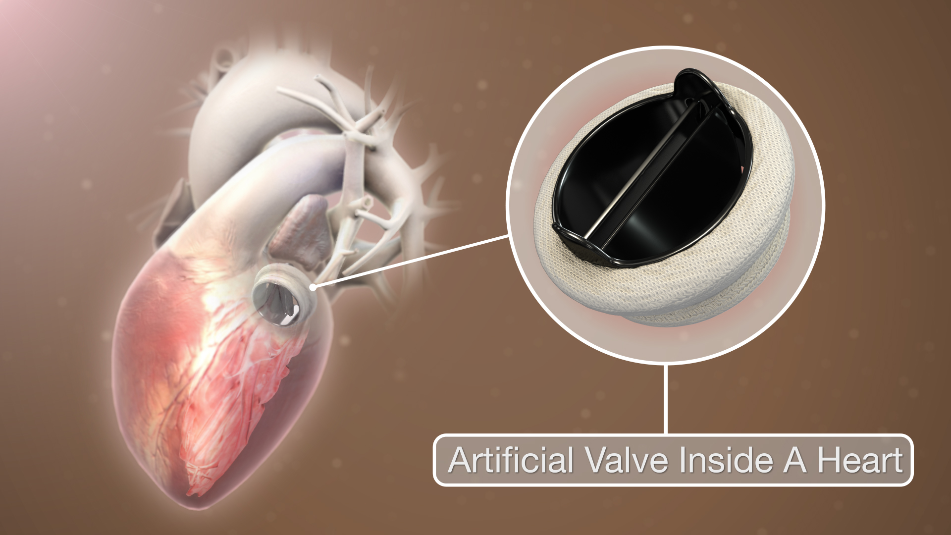 A 3D model of an artificial heart valve, demonstrating the application of engineering principles to replicate natural biological fluid dynamics.