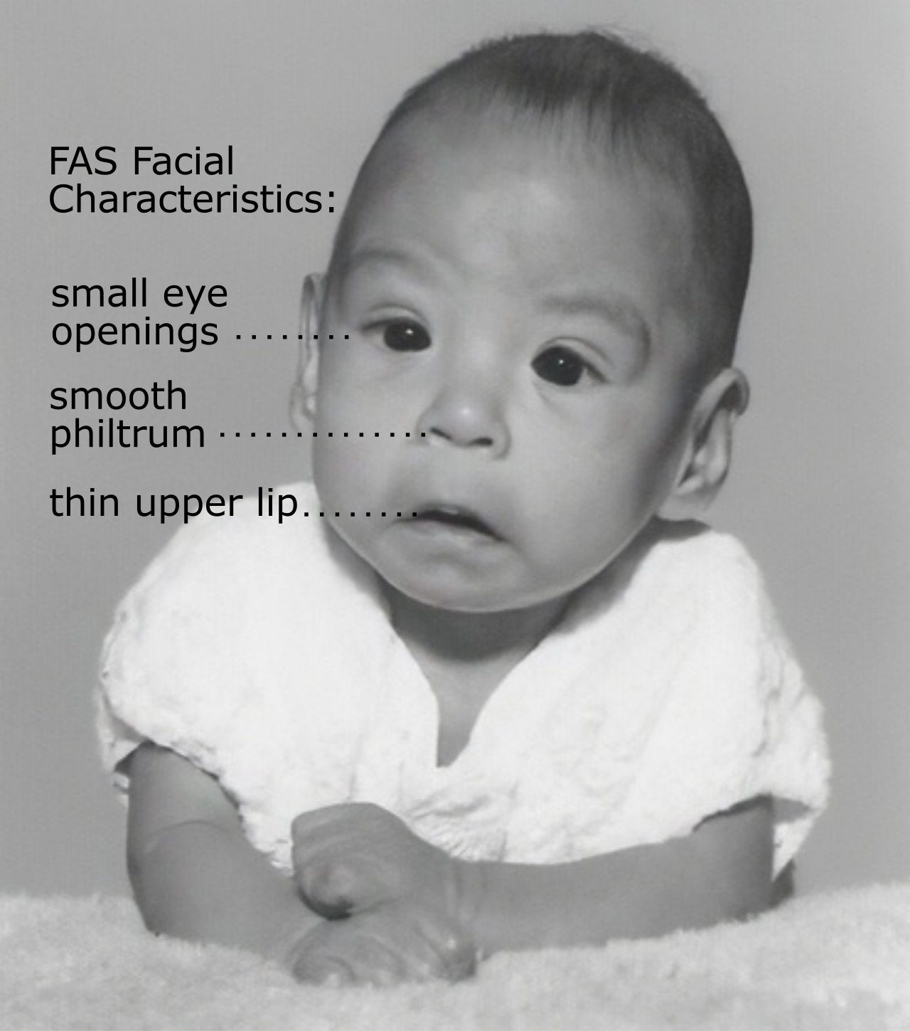 Prenatal exposure to environmental teratogens, such as alcohol, can lead to permanent structural anomalies and cognitive disabilities like Fetal Alcohol Syndrome.