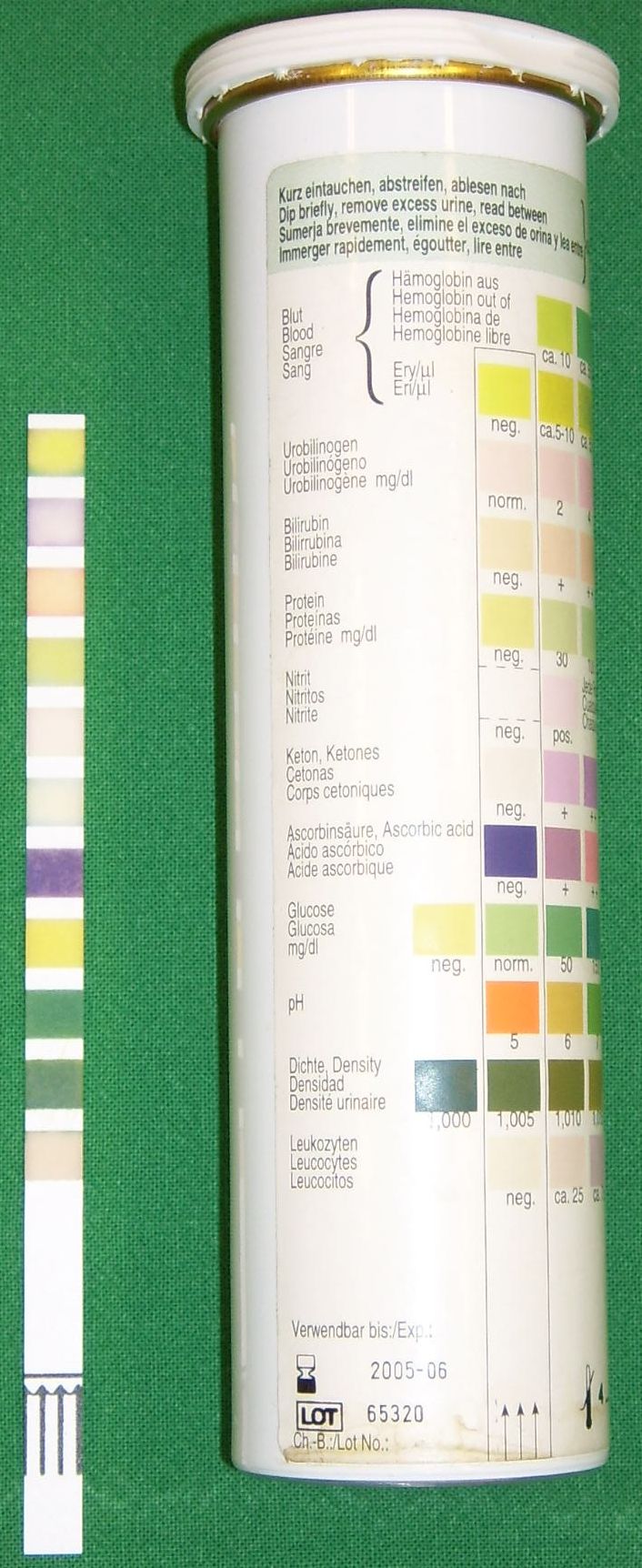 A rapid urine dipstick test. This simple bedside diagnostic tool provides immediate chemical clues about kidney function, diabetic ketoacidosis, or preeclampsia by detecting proteins, ketones, and glucose.