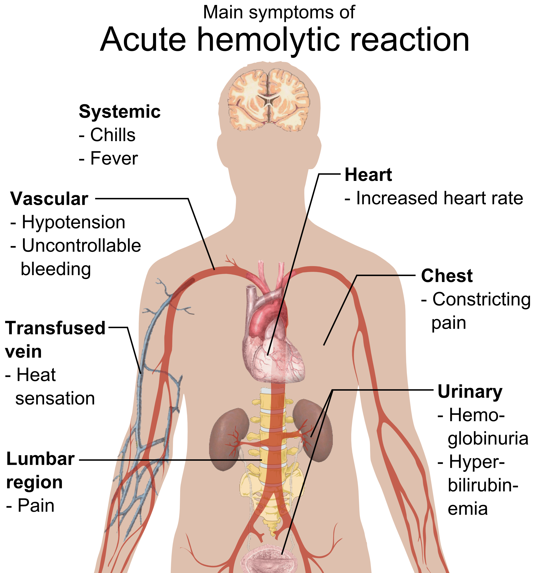 Classic systemic signs of an acute hemolytic transfusion reaction. Sudden lower back and flank pain are key indicators that the kidneys are becoming occluded by cellular debris from lysed red blood cells.