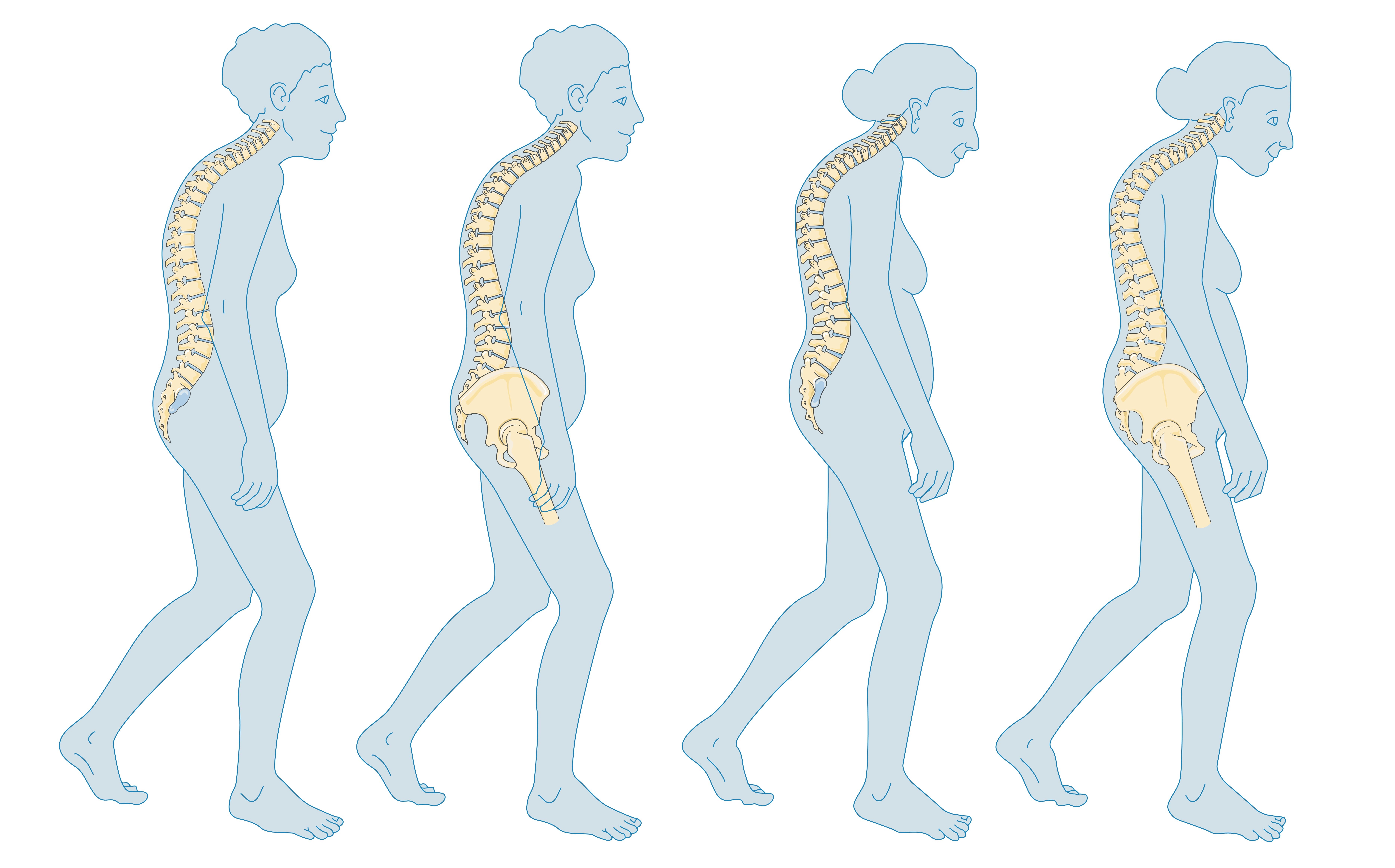 As estrogen levels drop after menopause, the balance of bone remodeling shifts, leading to osteoporosis and structural changes in the vertebral column. Regular DEXA screening is crucial to detect this early.