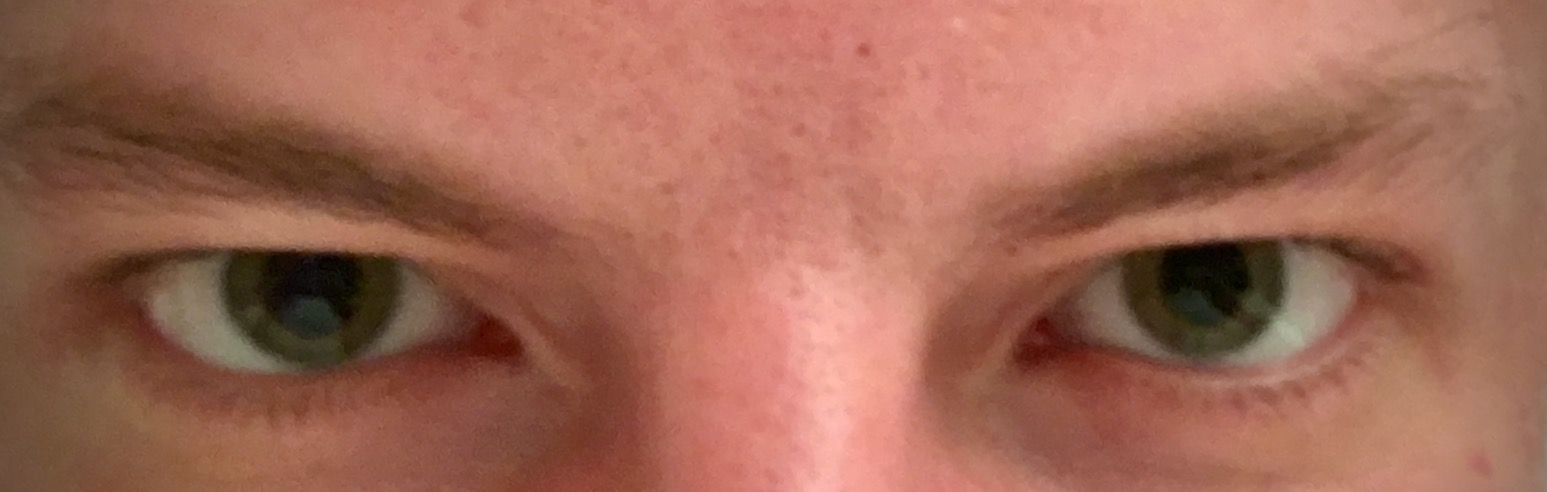 Pupillary dilation (mydriasis) allows more light to enter the eye, a direct physical manifestation of sympathetic nervous system activation during an acute stress state.
