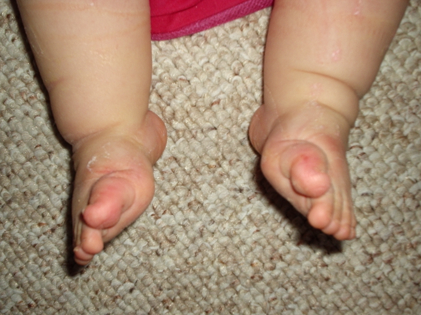 Clubfoot, a congenital anomaly, is an example of a structural physical condition that qualifies as an orthopedic impairment under IDEA if it adversely affects educational access and performance.