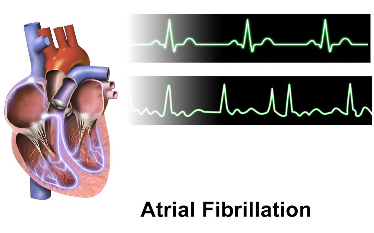 An electrocardiogram (ECG) comparing normal sinus rhythm (top) with atrial fibrillation (bottom). When scanning for clinical data on atrial fibrillation, you would locate the "Arrhythmias" subheading before analyzing the specific details.