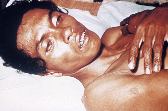 Severe fluid volume deficit leads to significantly decreased skin turgor and tissue dehydration, physically manifesting in signs like a dry, furrowed tongue or severe tenting of the skin.