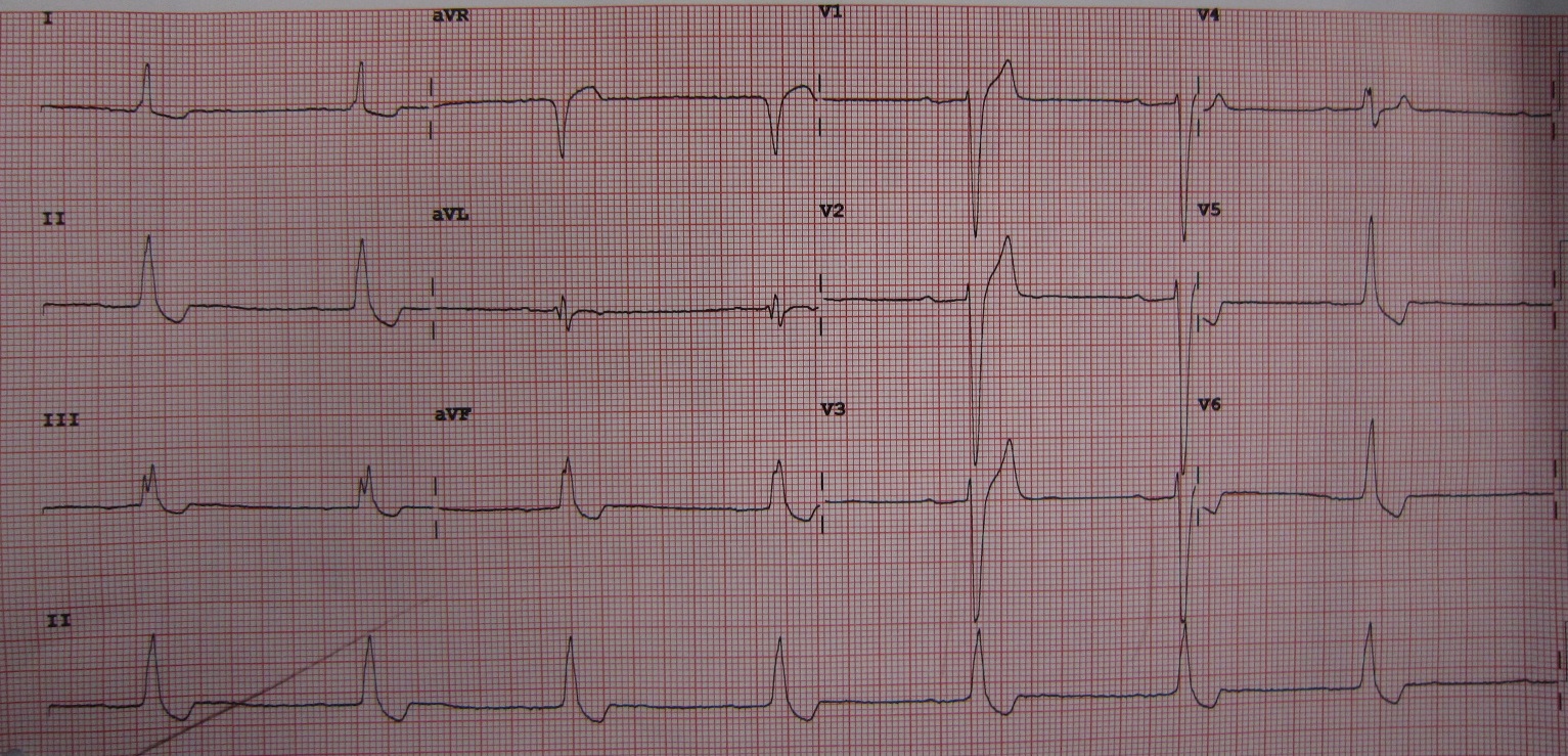 An electrocardiogram demonstrating the classic "scooped out" ST segment depression associated with digoxin use. Monitoring for digoxin toxicity is critical, particularly when the client is at risk for hypokalemia.