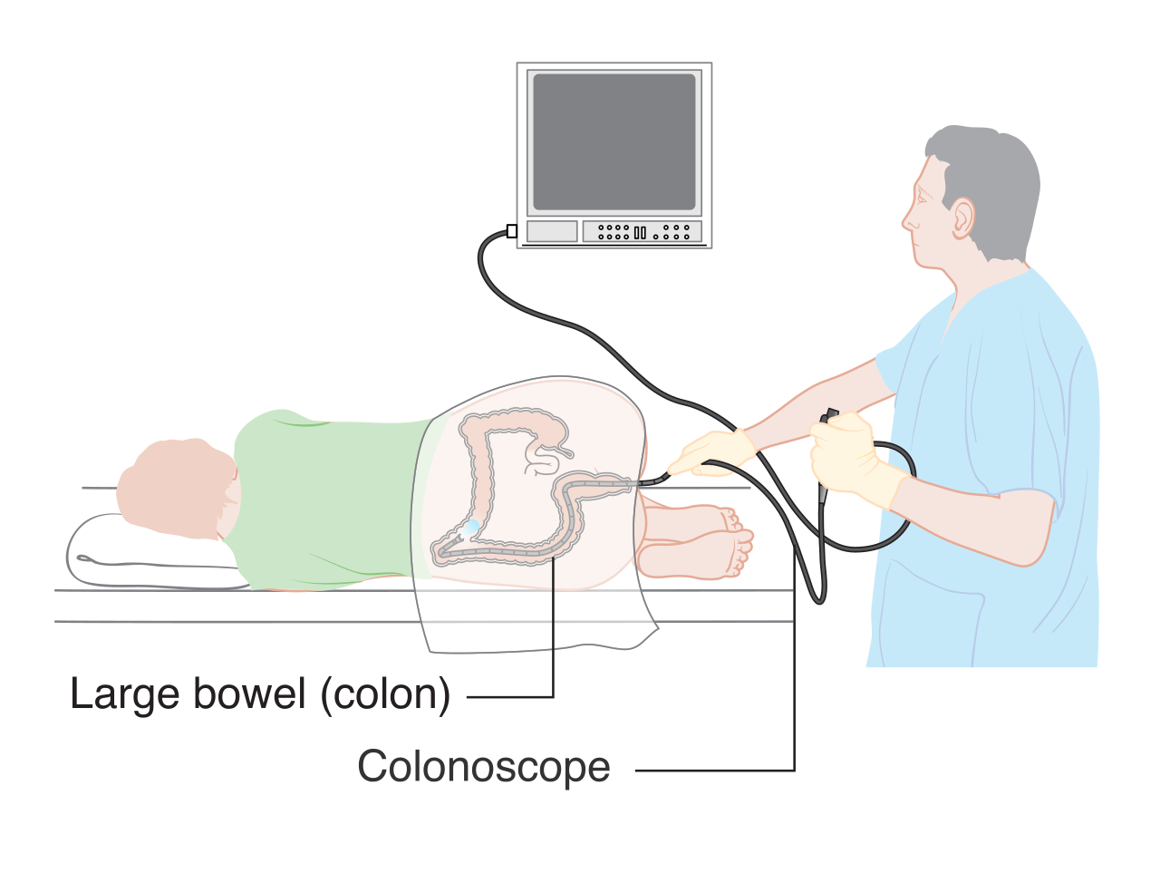 A schematic overview of a colonoscopy, a critical secondary prevention tool used to visualize the lower gastrointestinal tract and detect early-stage colorectal cancer.
