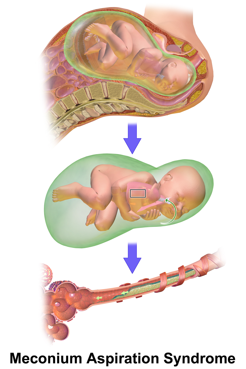 Diagram showing how fetal stress can trigger the release of meconium into the amniotic cavity, leading to Meconium Aspiration Syndrome.