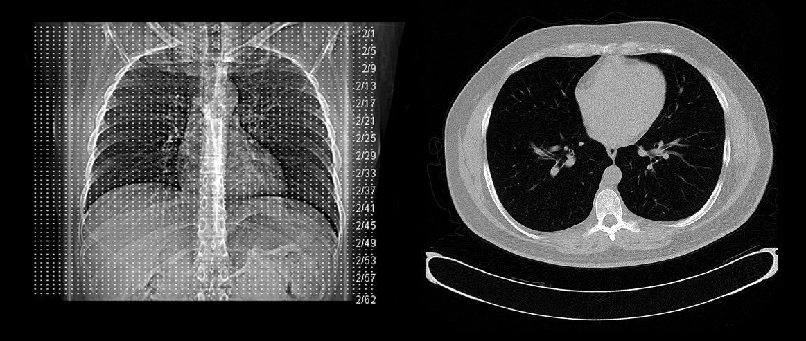 A medical CT scan relies on the geometric principle of cross-sections, slicing a three-dimensional human thorax into two-dimensional images to reveal internal structures.